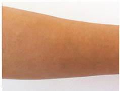 ひじ下脱毛After