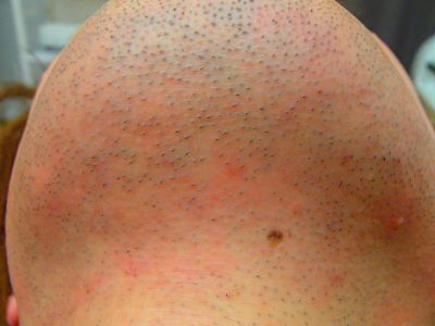 あご裏ひげ脱毛Before