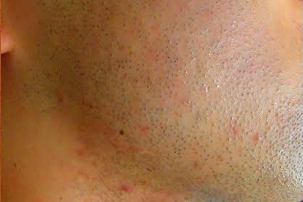 ほほひげ脱毛Before