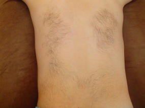 背中上脱毛Before