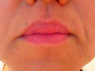 鼻下ひげ脱毛Before